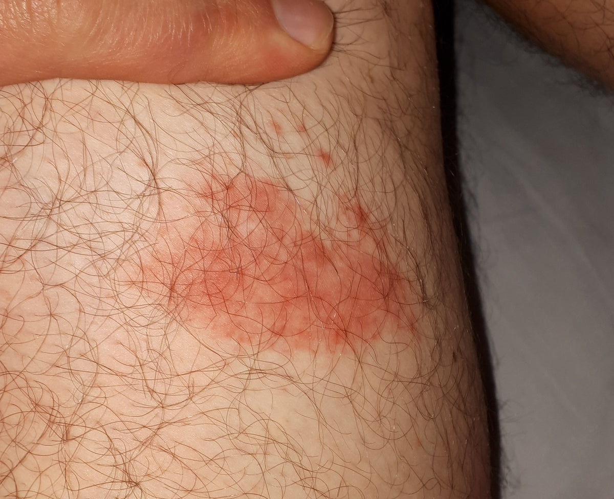 Image of an early atypical Lyme rash: what does it show?