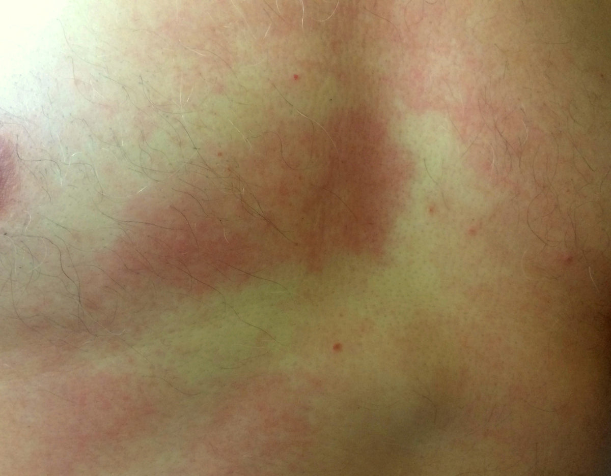 Image of a Lyme rash on the chest: what does it show?