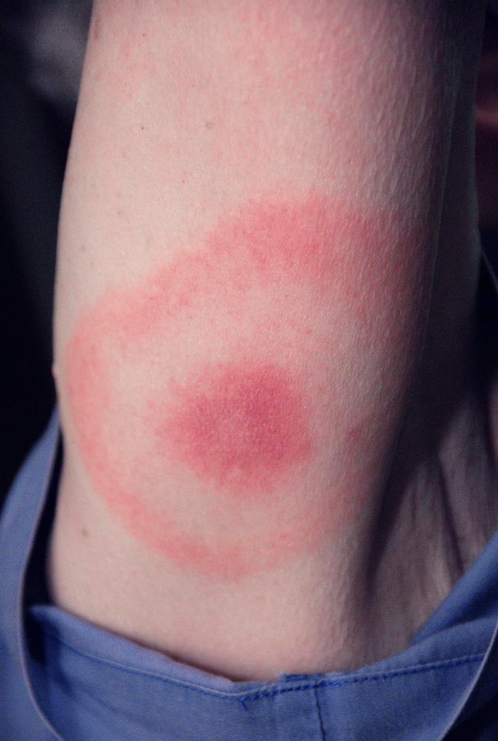 What can an erythema migrans rash look like?